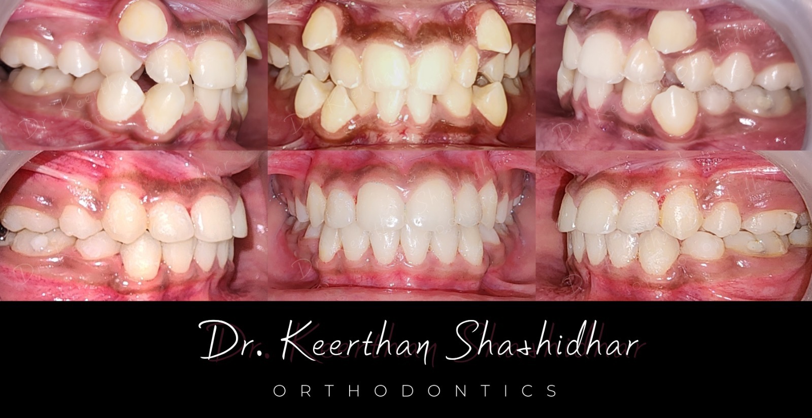 Before and after — severe dental crowding case