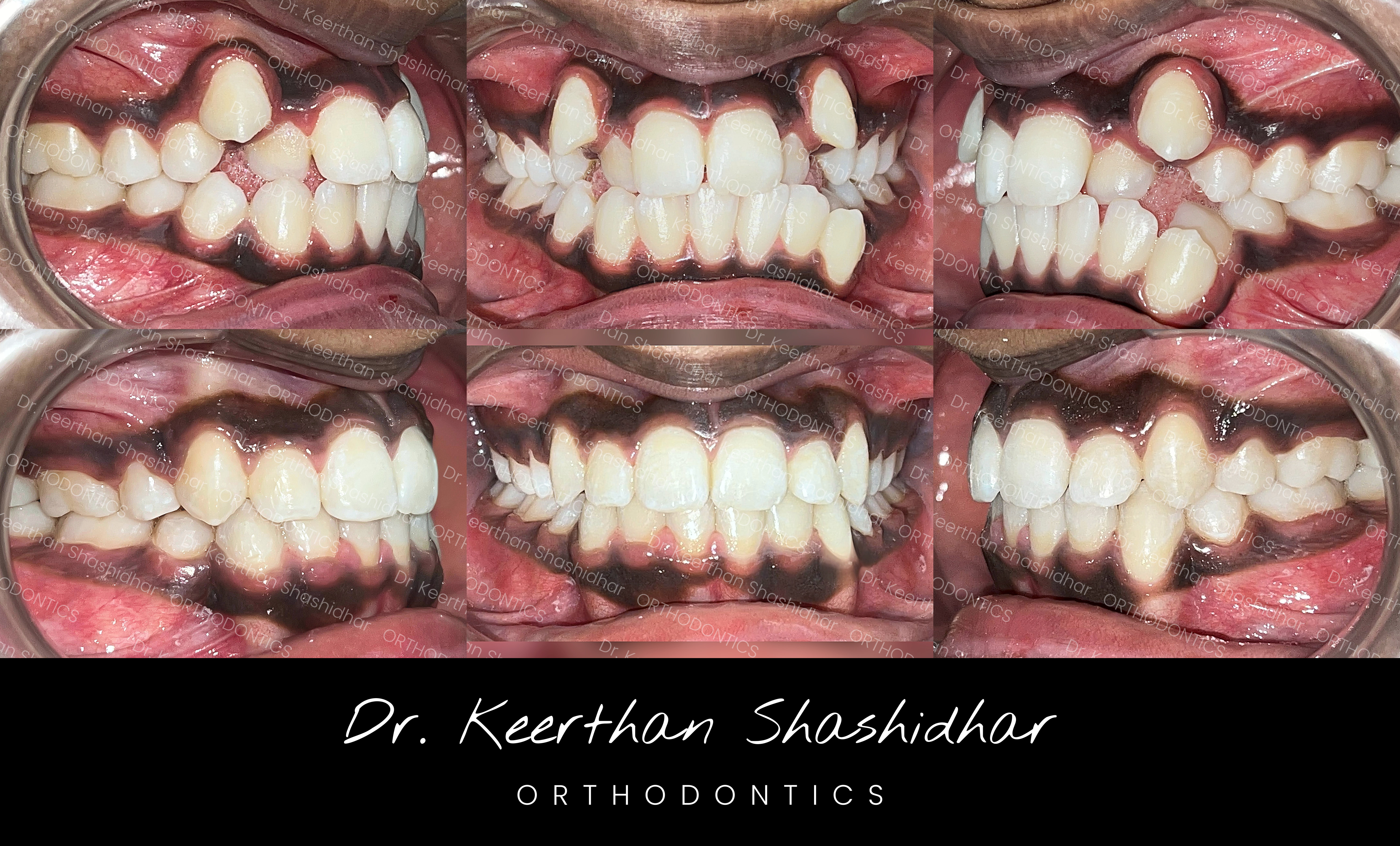 Angle's Class I malocclusion with three ectopically erupted canines, palatally locked lateral incisors, and severe anterior crowding, before and after treatment