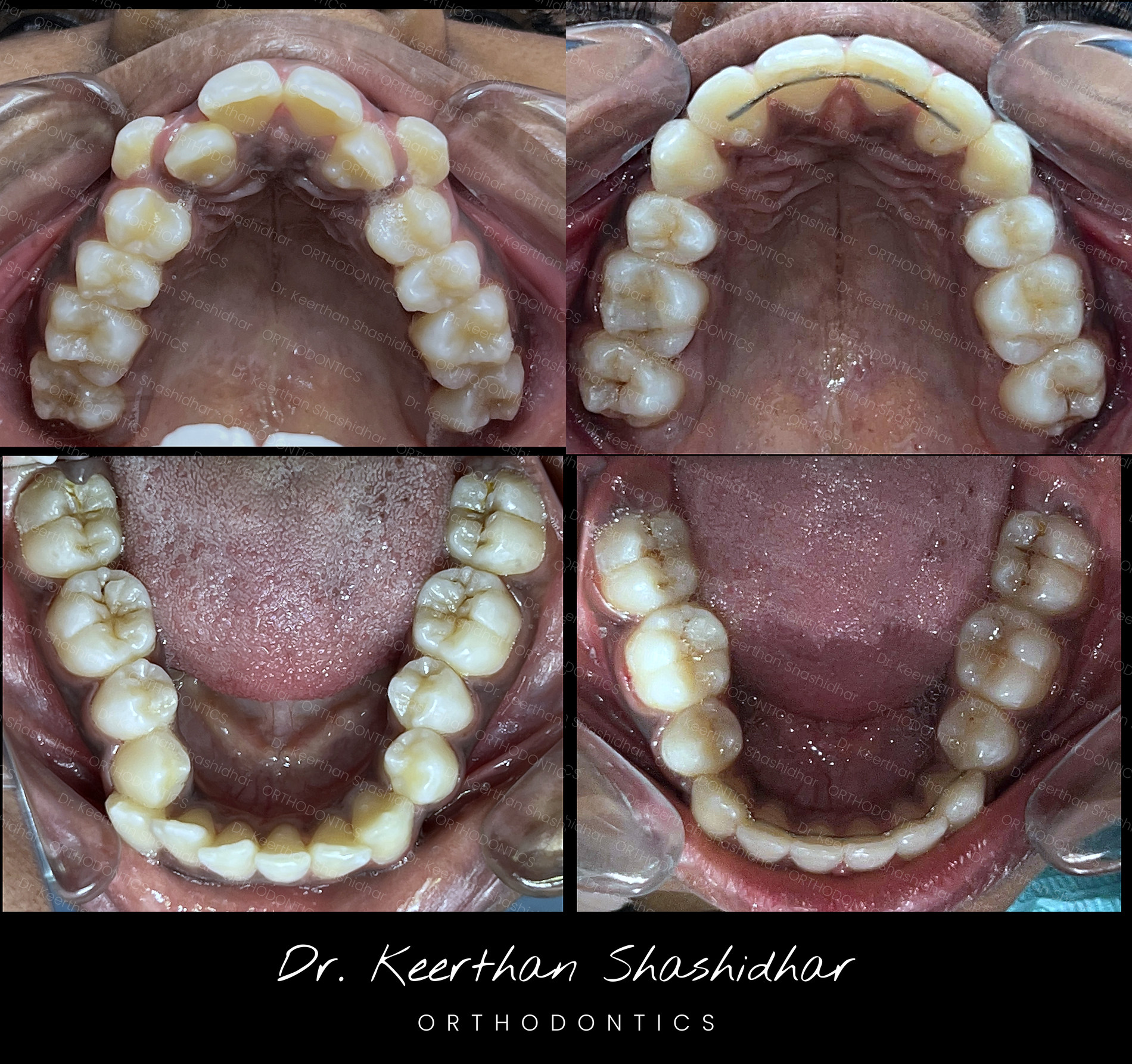 Severe crowding in the upper and lower arches, before and after treatment with premolar extraction and fixed retention