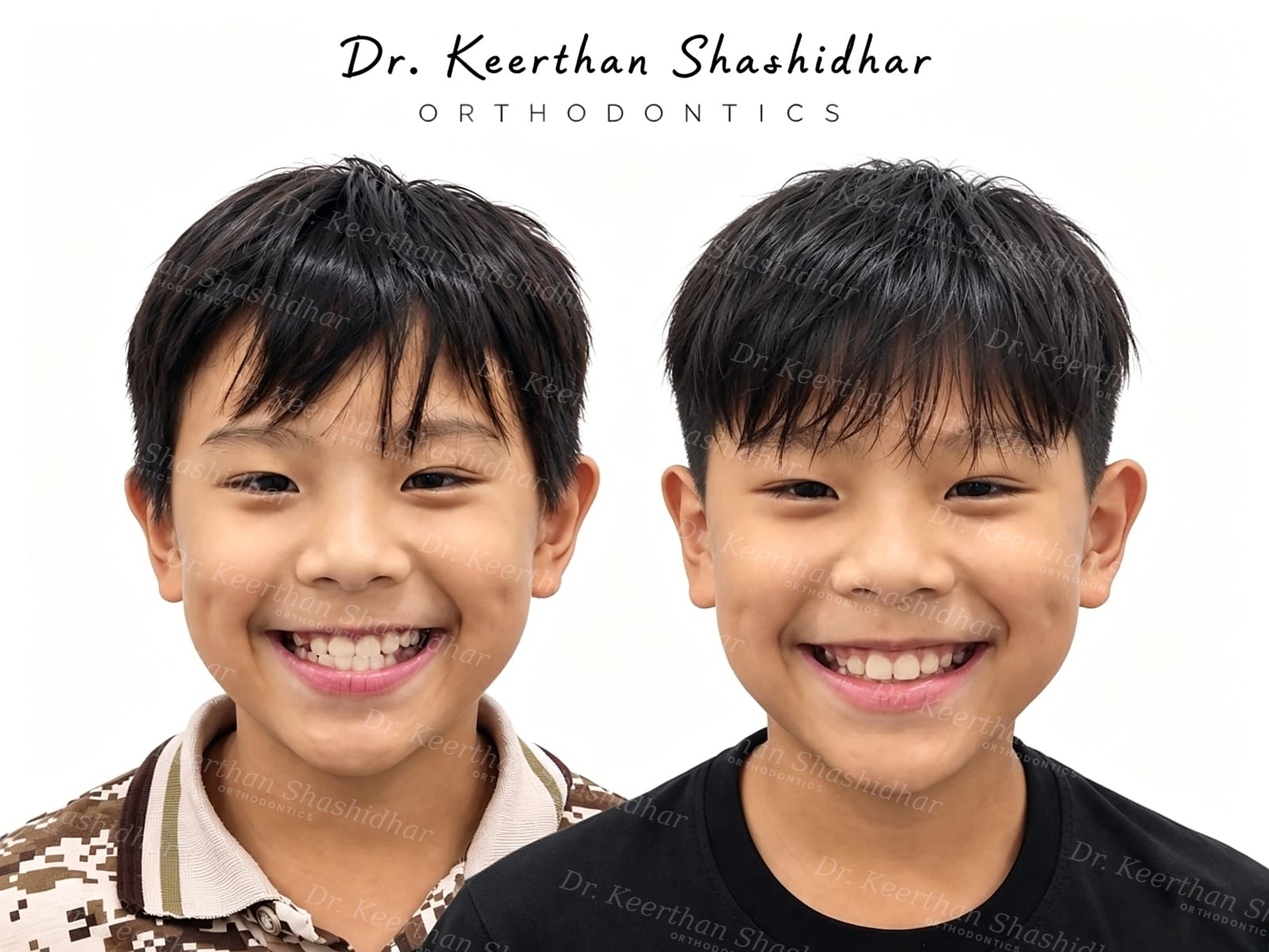 Before and after facial photographs — 10-year-old boy with skeletal Class III malocclusion and reverse overjet, corrected with reverse-pull headgear (facemask) therapy in 2 months