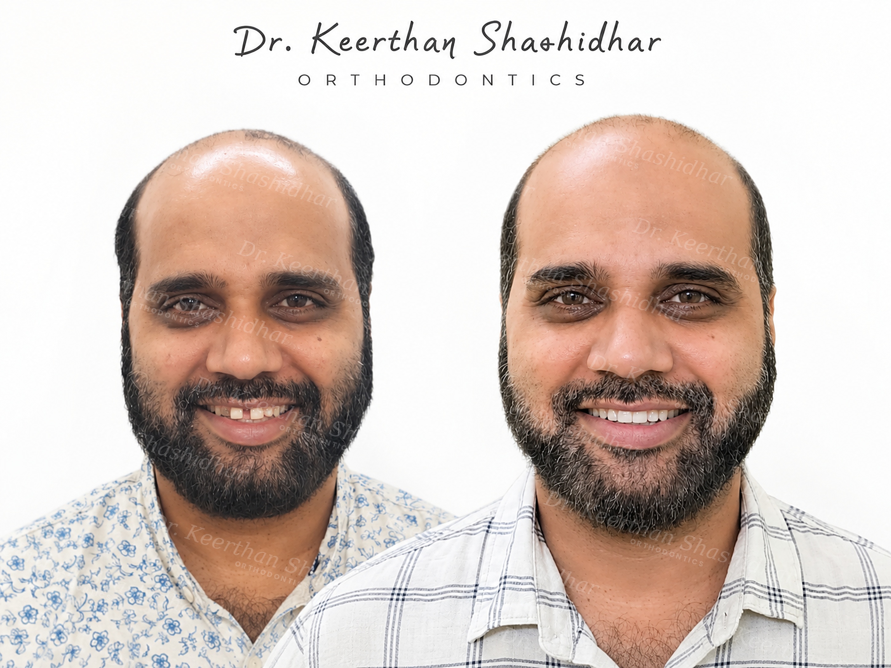 Before and after facial photographs — 45-year-old man with a 5mm midline diastema closed using clear aligners and fixed retention