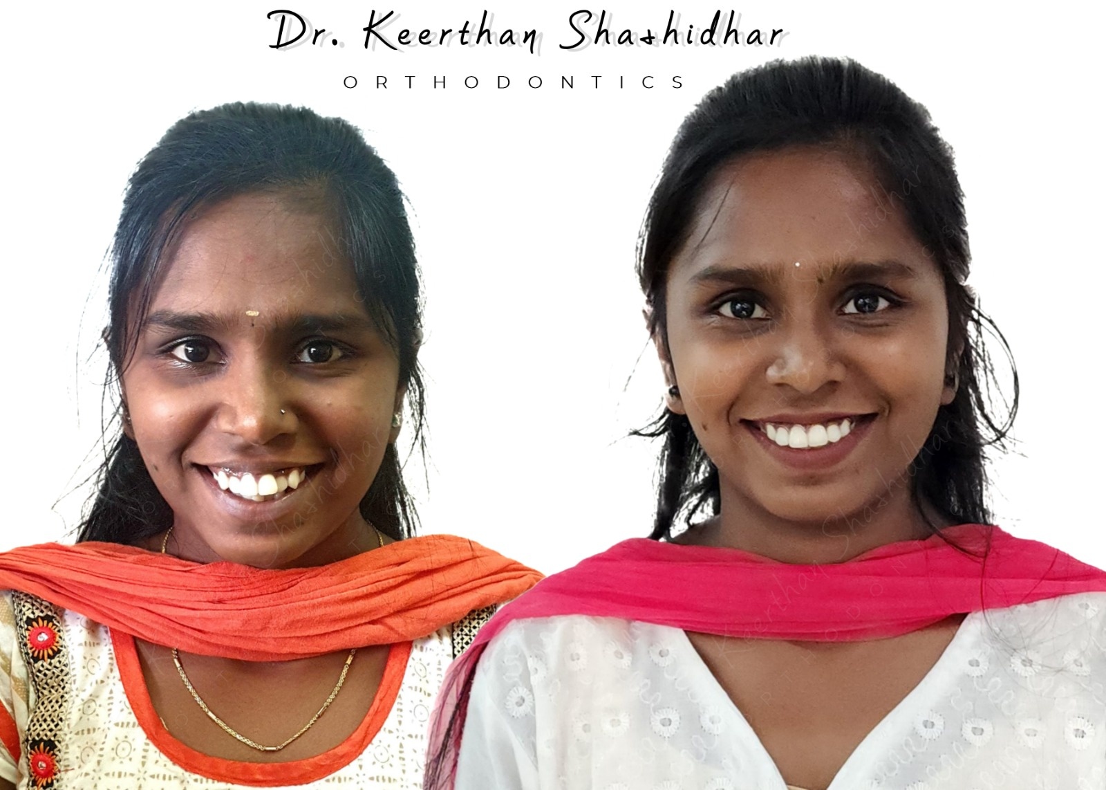 Before and after facial photographs — 16-year-old female with severe dental crowding, treated with extraction of all four first premolars