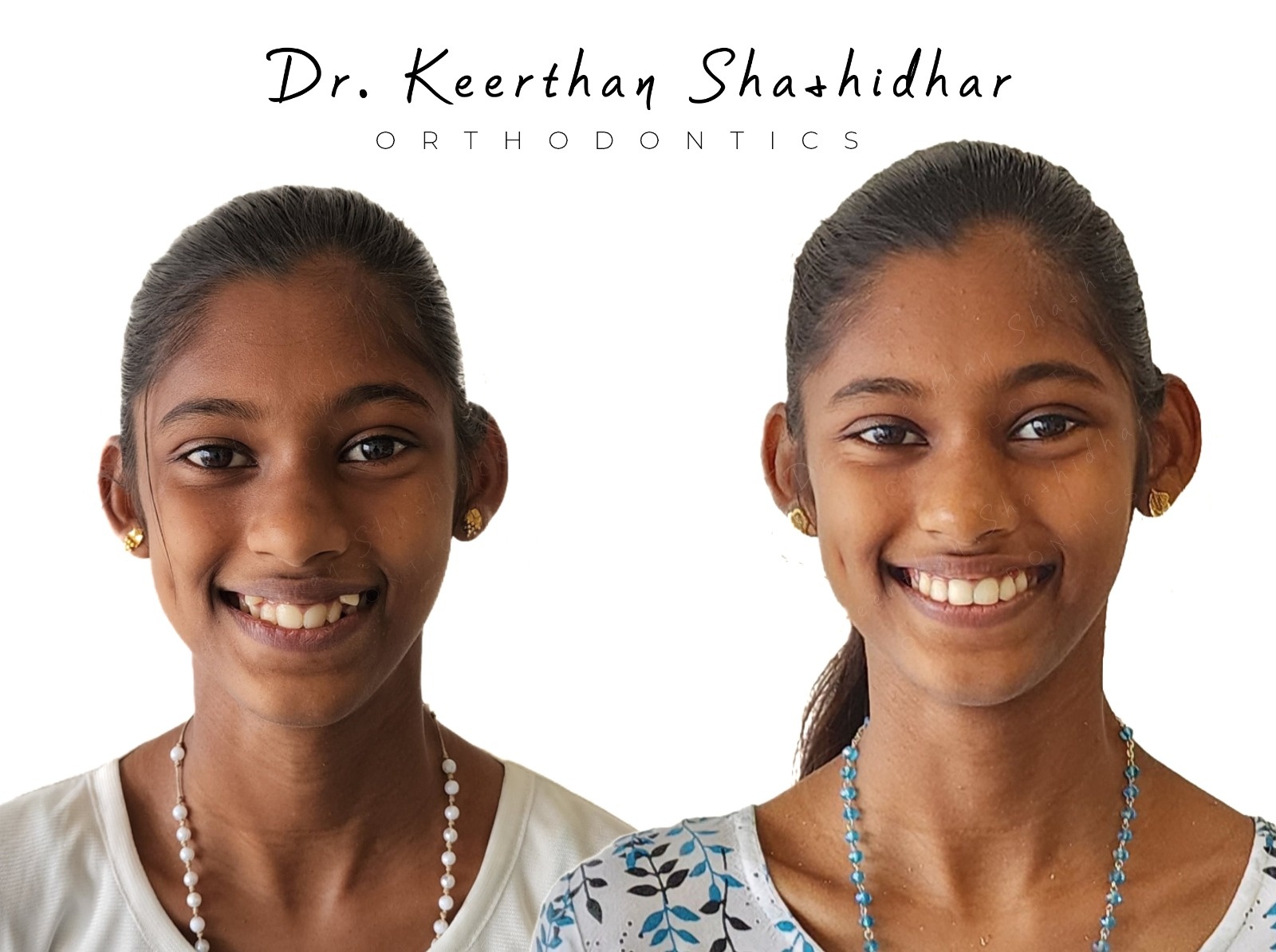 Before and after facial photographs — severe dental crowding with ectopic eruption of all four canines, treated with extraction of all four first premolars