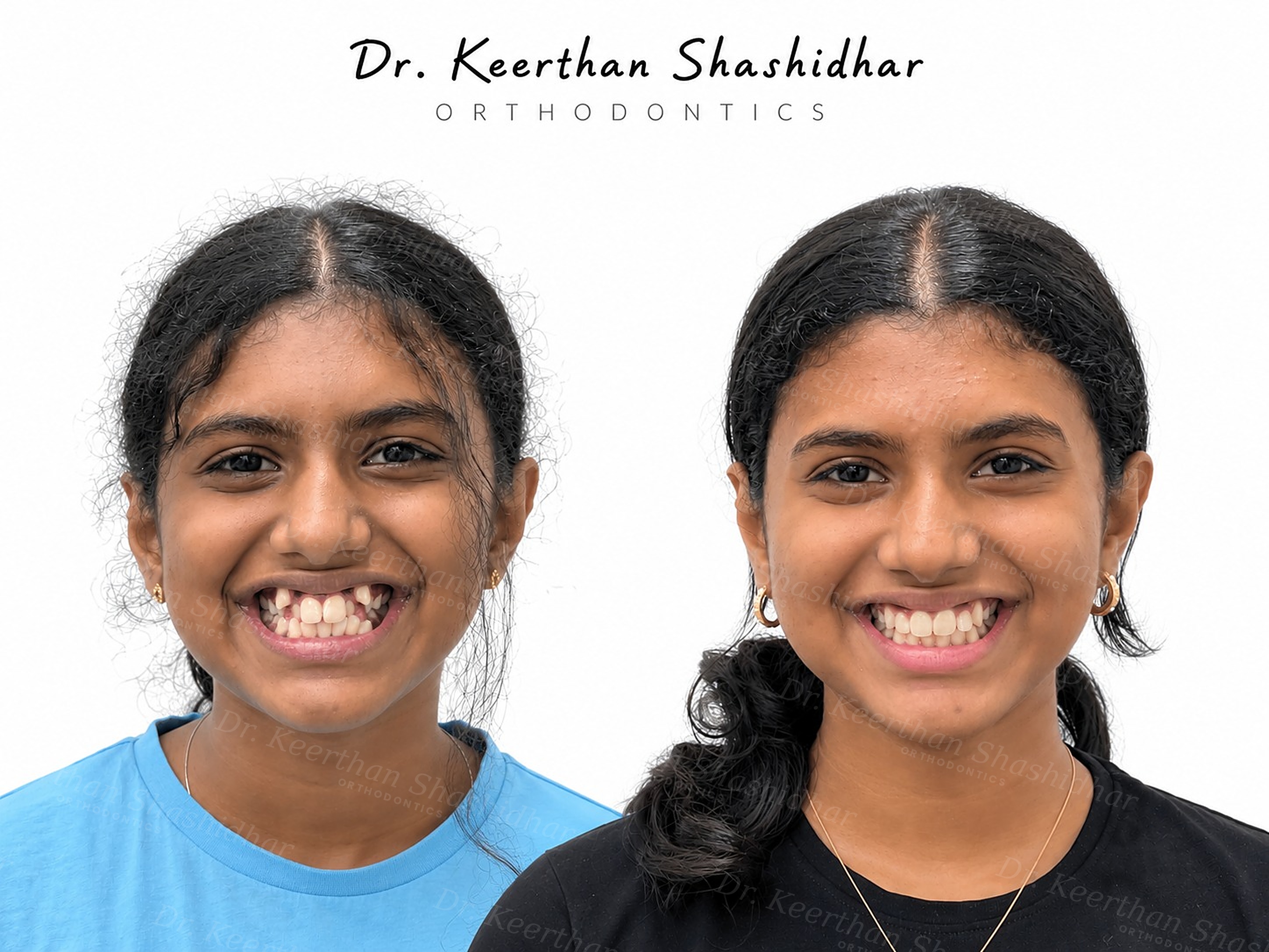 Before and after facial photographs — 15-year-old girl with severe dental crowding and three ectopic canines, treated with extraction of all four first premolars
