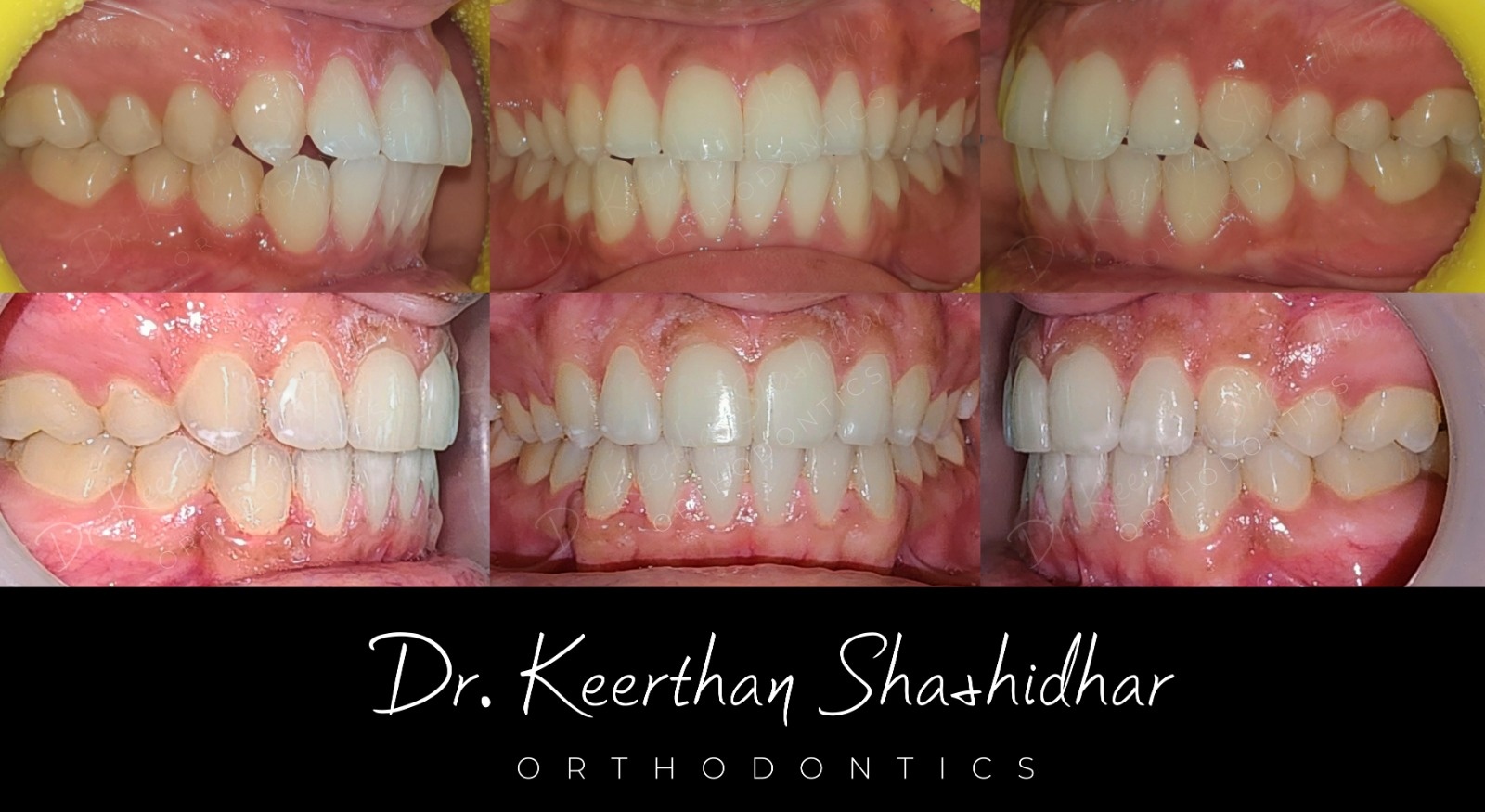Before and after — bimaxillary protrusion with mild crowding case