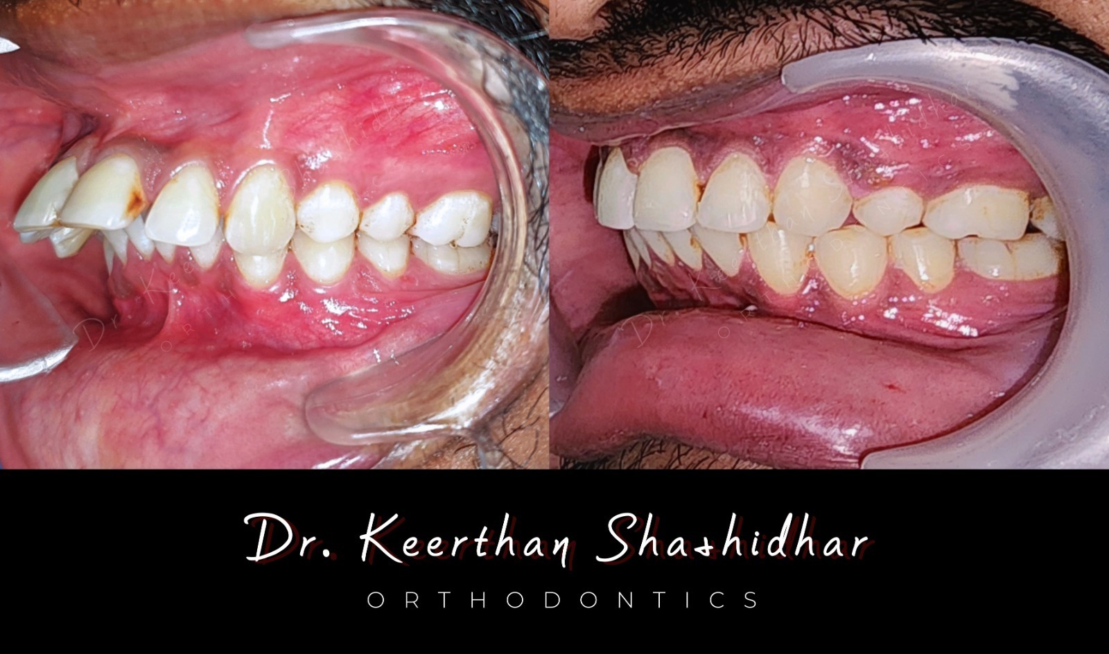 Before and after — Class II division 1 malocclusion with increased overjet and deep bite
