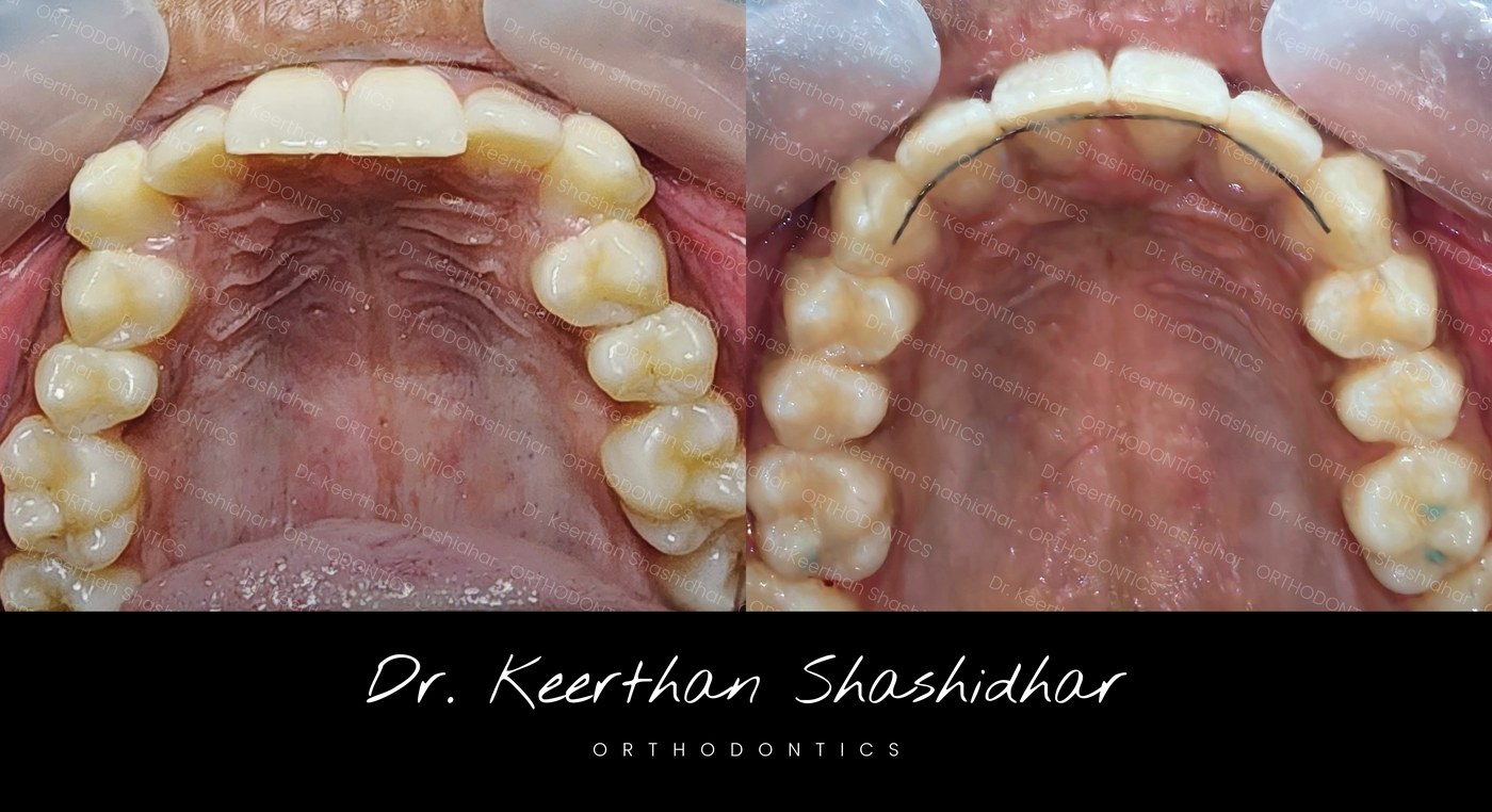 Before and after — arch crowding with fixed retainer