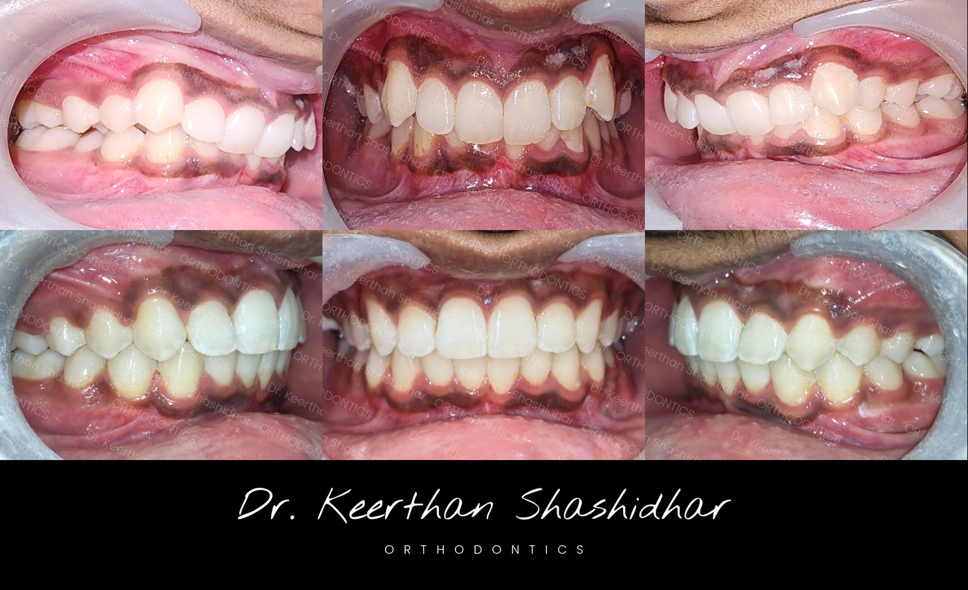 Before and after — anterior crowding and malocclusion