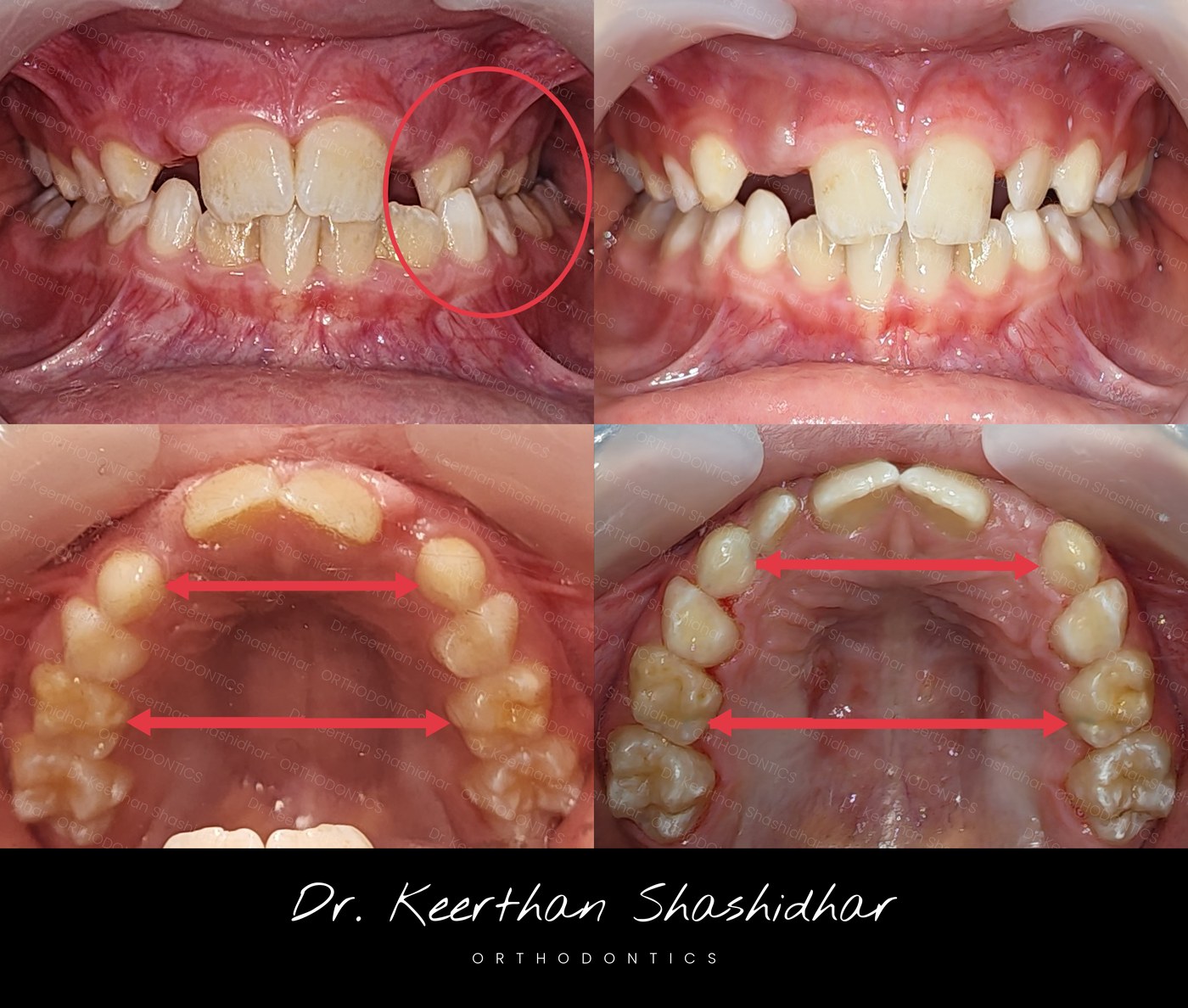Before and after — unilateral posterior crossbite corrected by rapid palatal expander