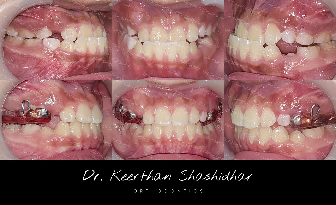 Before and mid-treatment — skeletal Class III malocclusion with maxillary retrognathism, facemask therapy