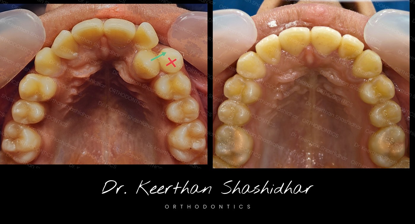 Retained deciduous canine, palatally displaced permanent canine guided into place