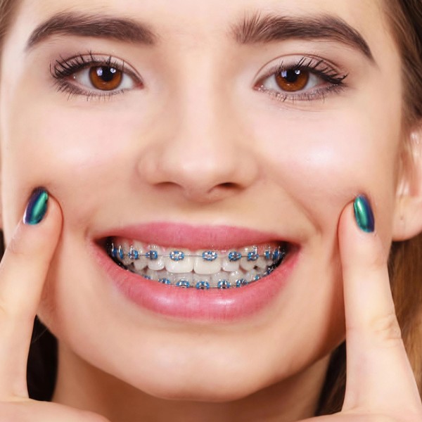 Close-up smile with braces and colourful elastic modules