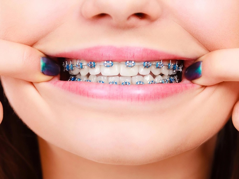 Close-up of conventional metal braces with colourful blue elastic modules