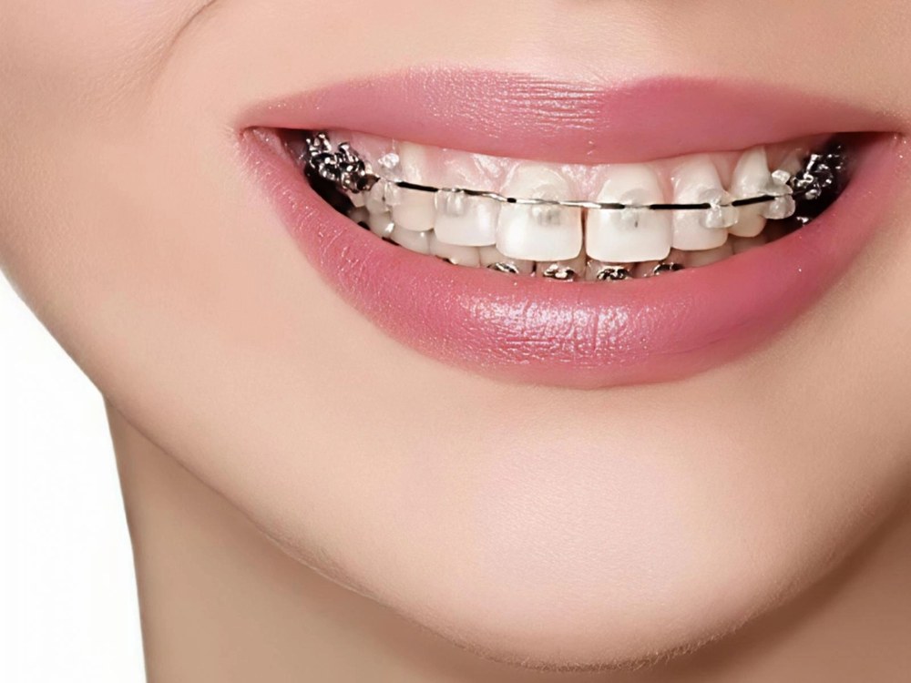 Close-up smile with Damon Clear ceramic braces