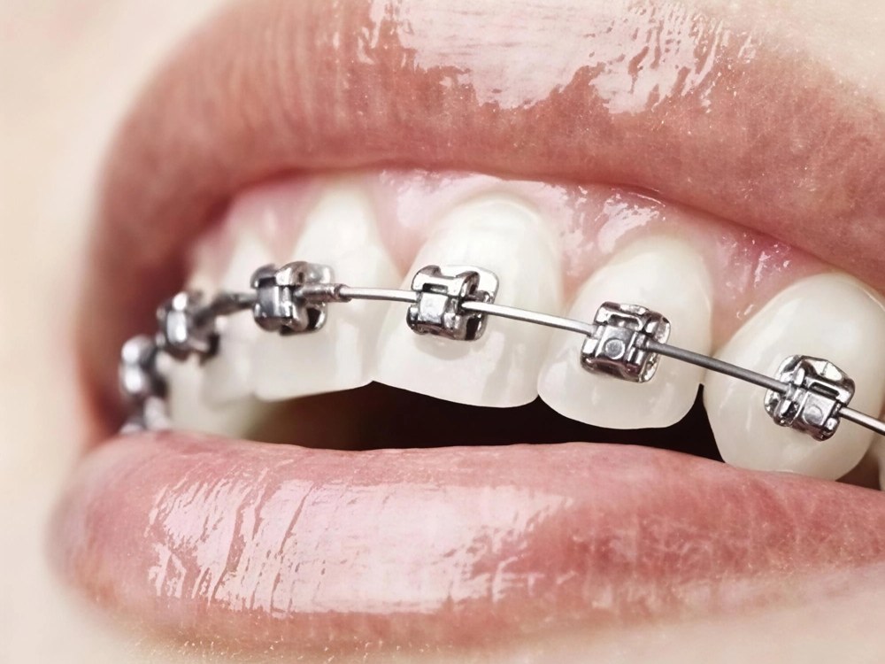 Close-up of Damon self-ligating metal braces