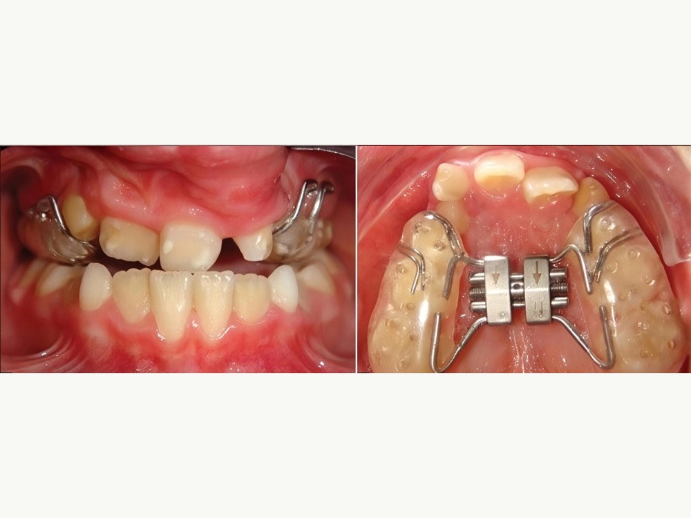 Intraoral view of the expansion appliance with hooks that anchor the face mask elastics