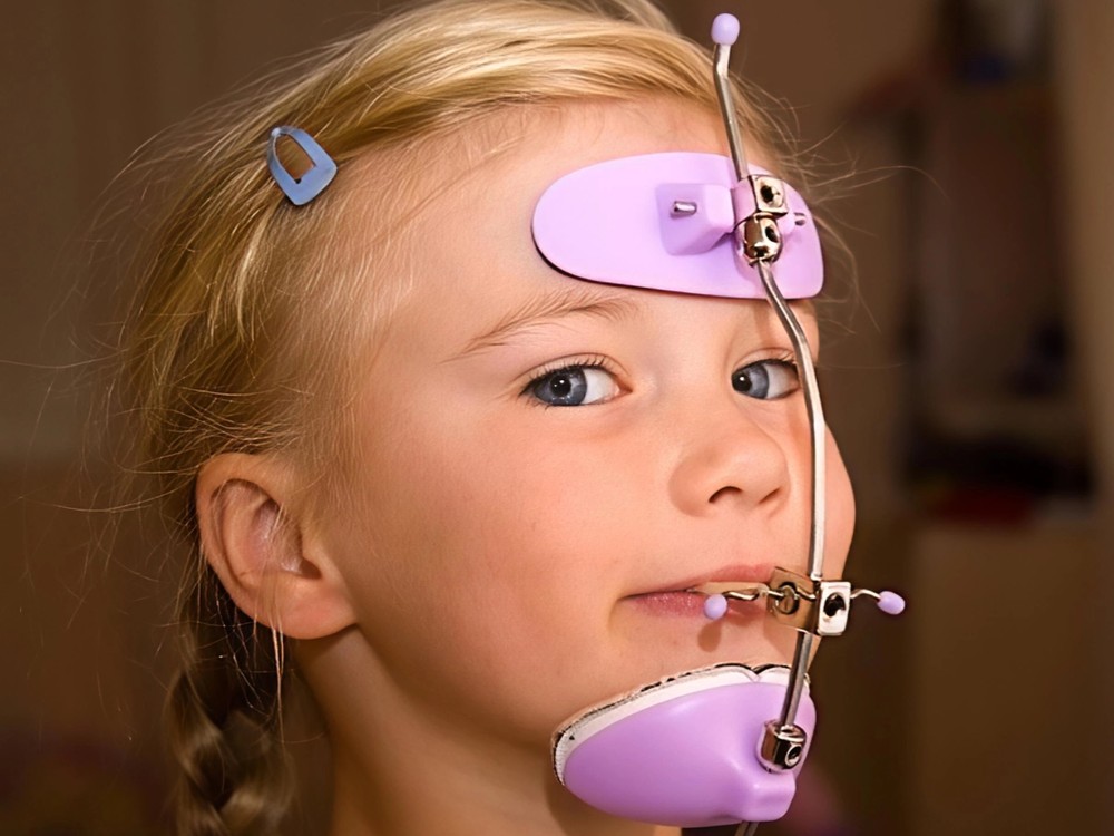 Child wearing a face mask (reverse-pull headgear) appliance