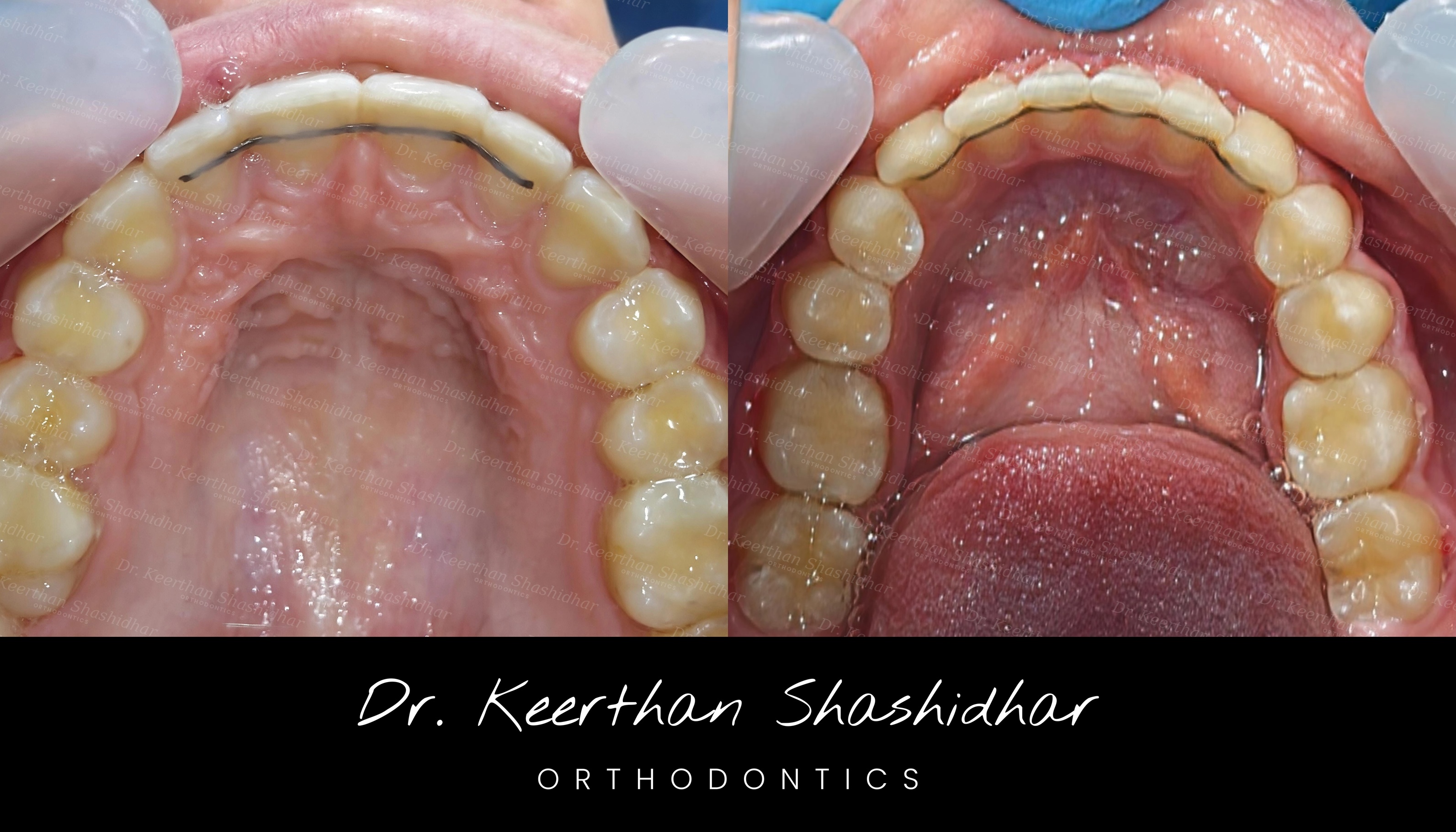 Fixed retainer wire bonded behind the upper front teeth (left) and lower front teeth (right)