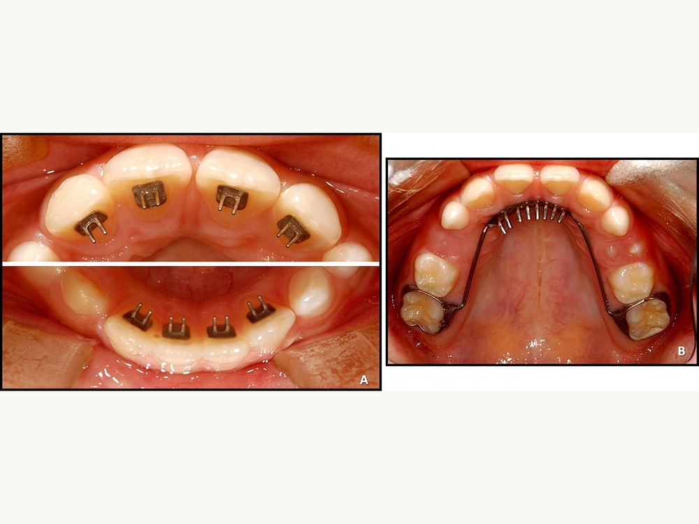 Collage comparing a tongue crib appliance with lingual spurs