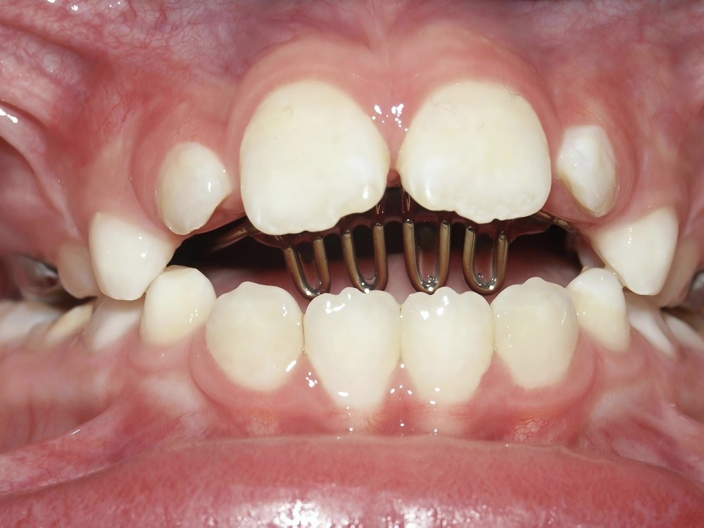 Tongue crib / palatal crib appliance fitted in the upper arch