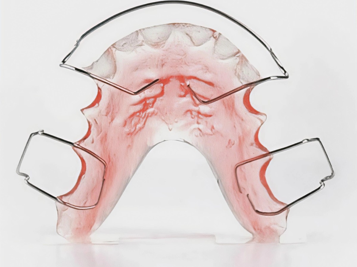 Hawley's retainer appliance on its own, showing the acrylic plate and wire clasps