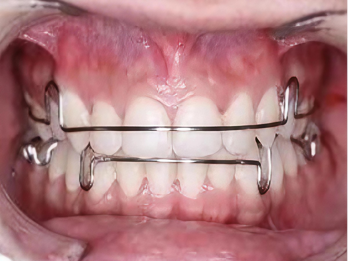 Hawley's retainer worn in the mouth, wire bow across the upper and lower front teeth