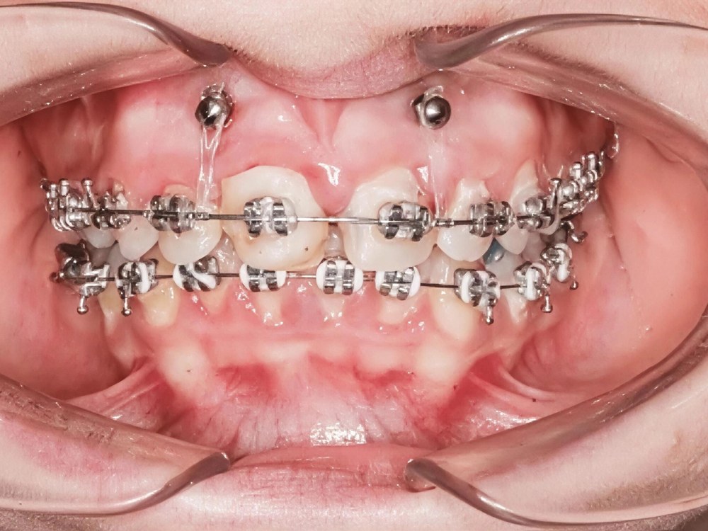 Close-up of braces with mini implants (TADs) anchored above the upper front teeth
