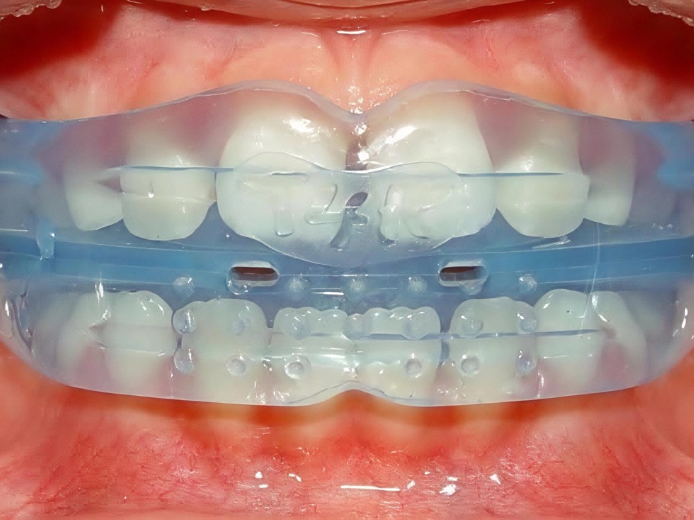 Myobrace appliance fitted in the mouth