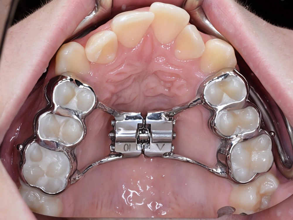 Rapid Maxillary Expansion (RME) appliance banded onto the upper molars