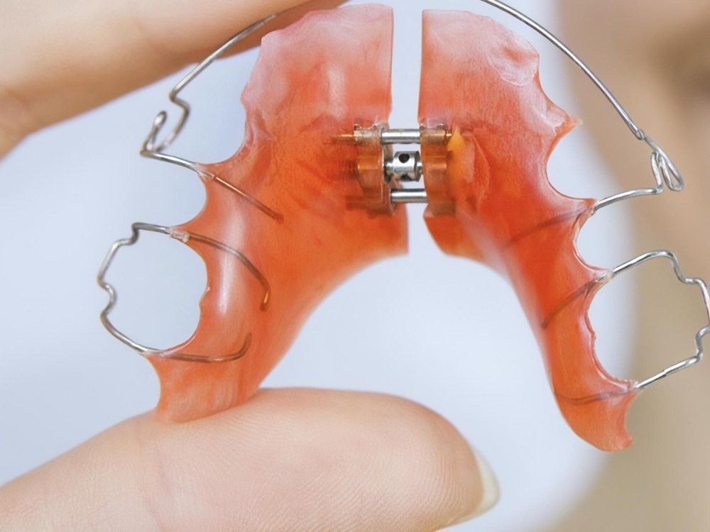 Slow Maxillary Expansion (SME) removable acrylic expander appliance