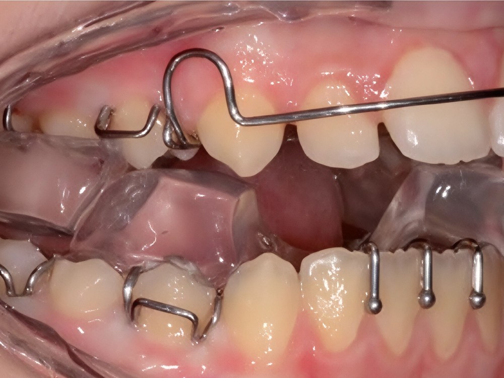 Twin Block appliance fitted in the mouth, showing the upper and lower acrylic blocks and wire clasps